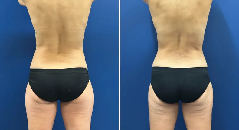 Before and after tummy tuck: patient's abdomen from the back, with breast augmentation with lift and liposuction