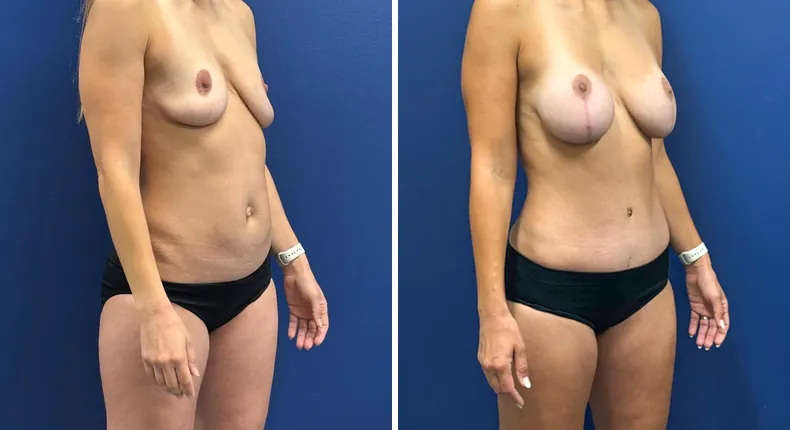 Before and after tummy tuck: patient's abdomen at a right angle, with breast augmentation with lift and liposuction