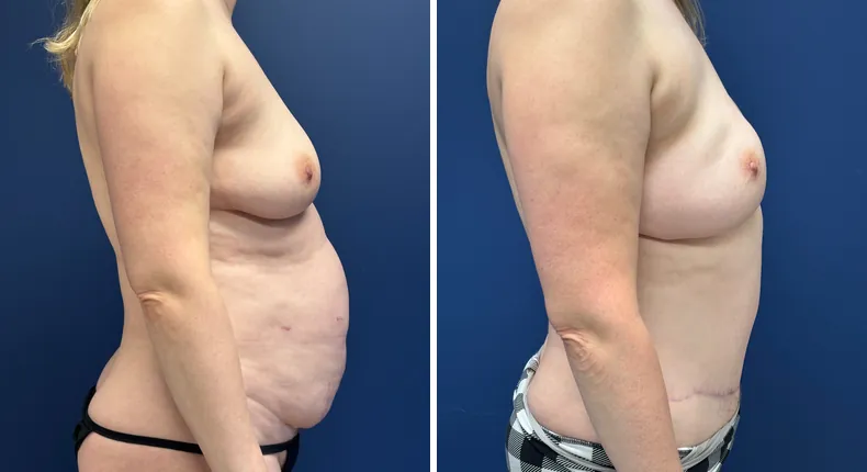 Before and after tummy tuck: woman's abdomen from the right side, with liposuction and breast reconstruction