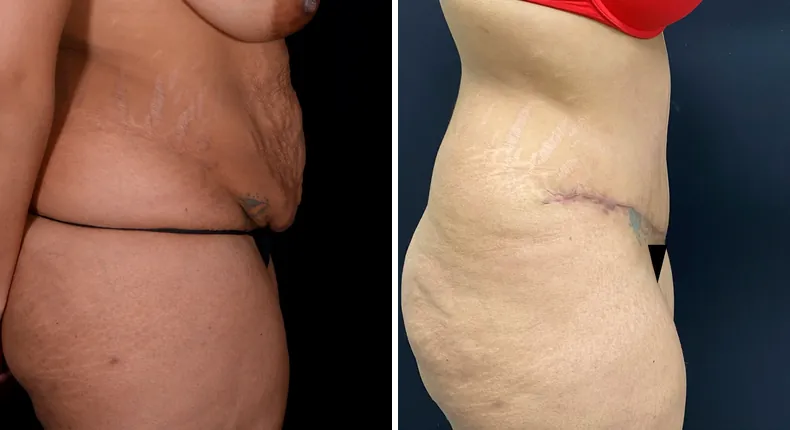 Before and after tummy tuck: woman's abdomen from the right side, with liposuction