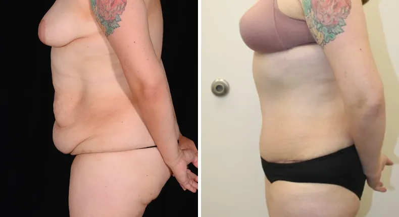 Before and after tummy tuck: patient's abdomen from the left side, with liposuction