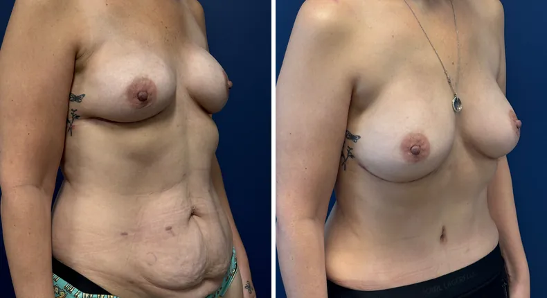 Before and after tummy tuck: patient's abdomen from the right side, with diep flap