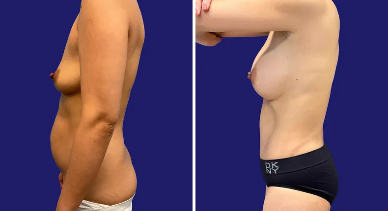 Before and after tummy tuck: woman's abdomen, with breast augmentation, liposuction and mommy makeover