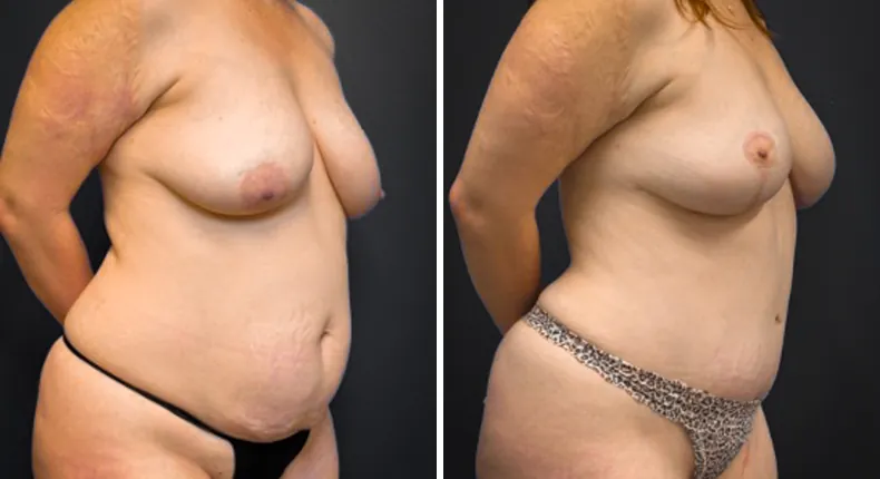 Before and after tummy tuck: patient's abdomen at a right angle