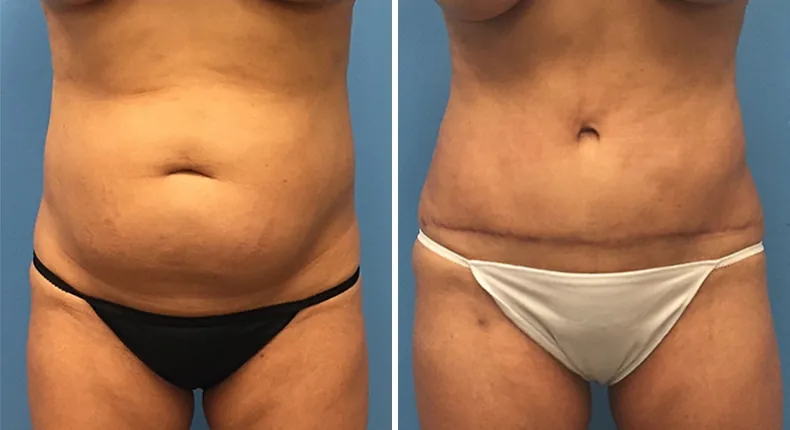 Before and after tummy tuck: woman's abdomen from the front, with liposuction