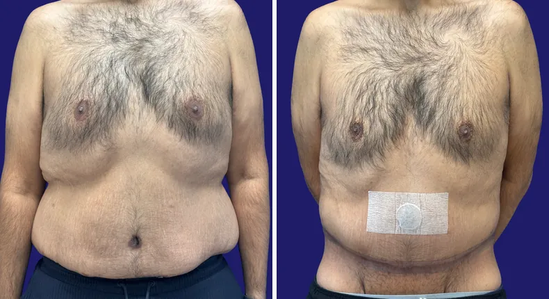 Before and after tummy tuck: man's abdomen from the front, with liposuction and body lift