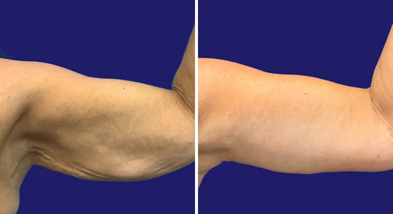 Before and after tummy tuck: woman's abdomen, with breast augmentation, breast lift, liposuction, mommy makeover and arm lift