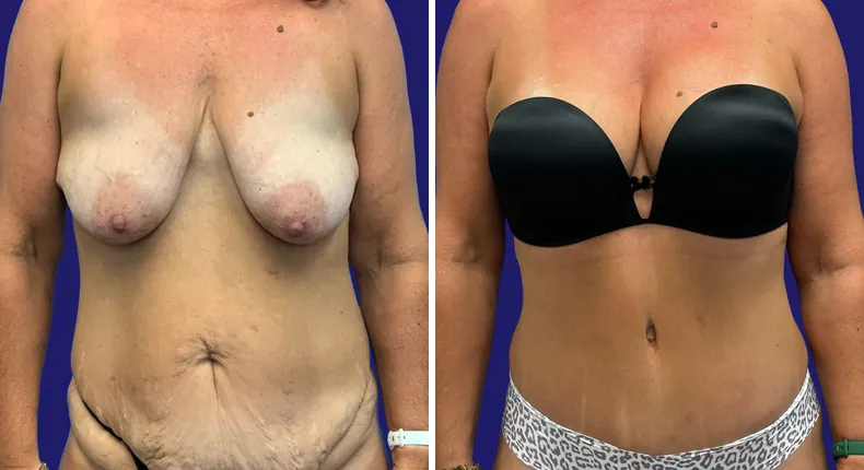 Before and after tummy tuck: woman's abdomen, with breast augmentation, breast lift, liposuction, mommy makeover and arm lift