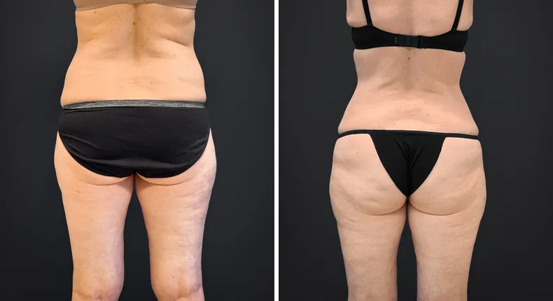 Before and after tummy tuck: patient's abdomen from the back