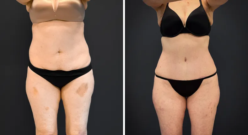 Before and after tummy tuck: patient's abdomen from the front