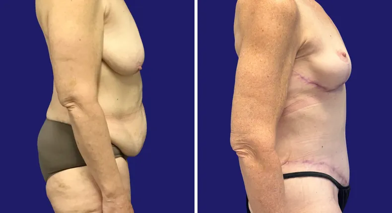 Before and after tummy tuck: woman's abdomen, with liposuction and mommy makeover