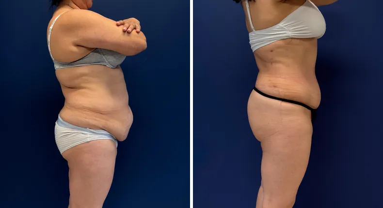 Before and after tummy tuck: patient's abdomen