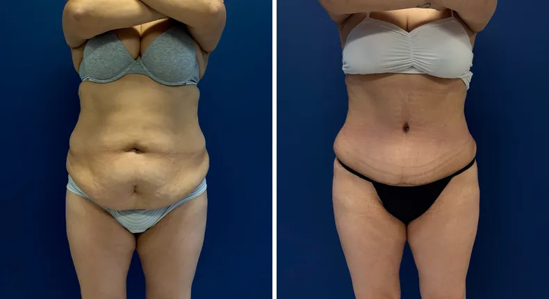 Before and after tummy tuck: patient's abdomen