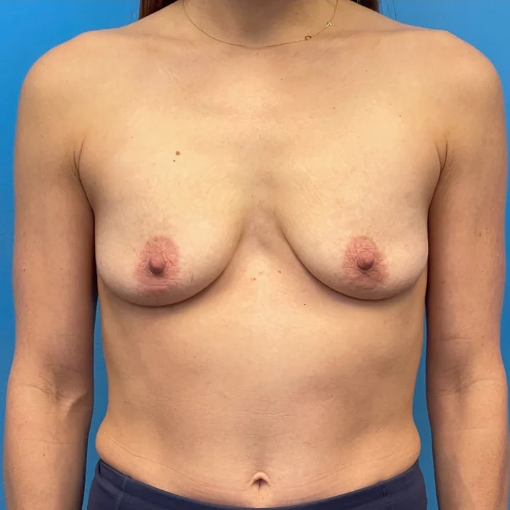 Before breast lift, front view, patient of Dr. Samir Rao