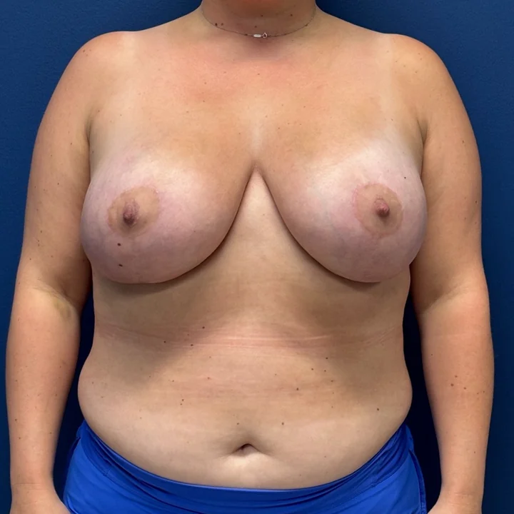 After breast lift, front view, patient of Dr. Samir Rao
