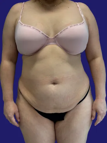 Tummy Tuck Case #1259 — before, Dr. Frank Albino