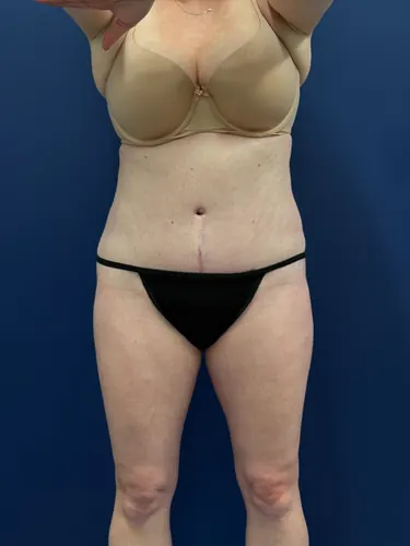 Tummy Tuck Case #1715 — after, Dr. Samir Rao