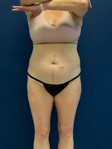 Tummy Tuck Case #1715 — before, Dr. Samir Rao