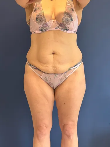 Tummy Tuck Case #1856 — before, Dr. Samir Rao