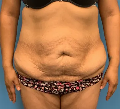 Tummy Tuck Case #23747 — before, Dr. Arjun Kanuri
