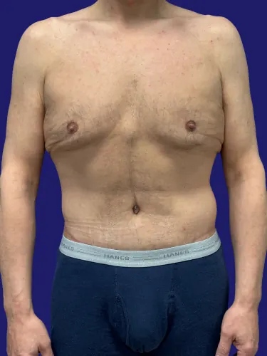 Tummy Tuck Case #2524 — after, Dr. Frank Albino