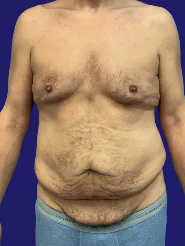 Tummy Tuck Case #2524 — before, Dr. Frank Albino