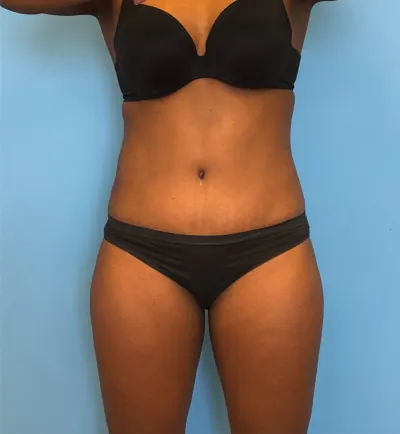 Tummy Tuck Case #28134 — after, Dr. Samir Rao