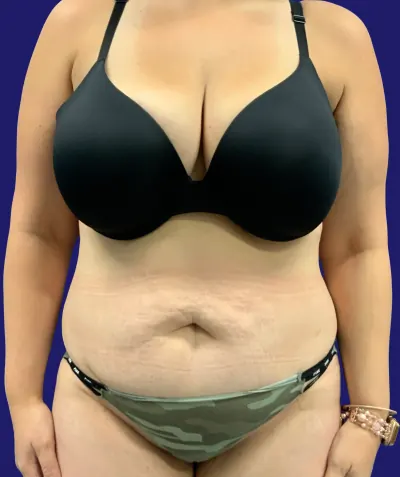 Tummy Tuck Case #3073 — before, Dr. Frank Albino