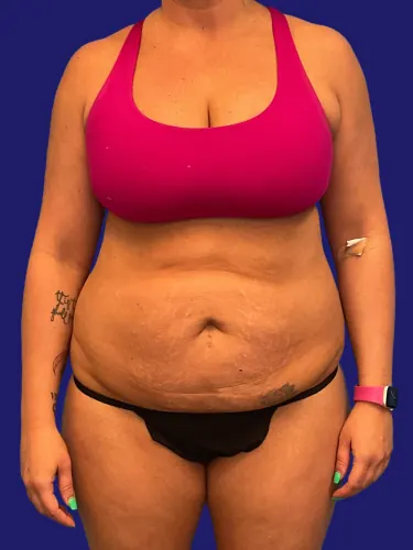Tummy Tuck Case #3117 — before, Dr. Frank Albino