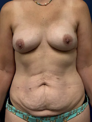 Tummy Tuck Case #4660 — before, Dr. Frank Albino