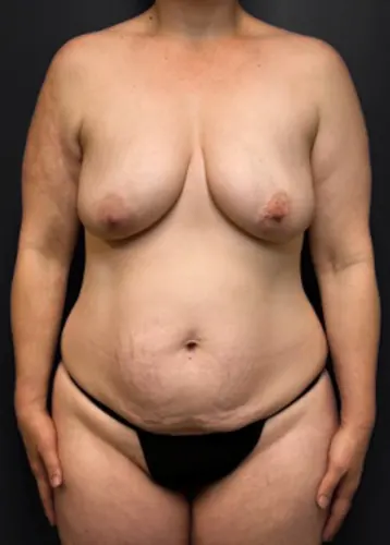 Tummy Tuck Case #5347 — before, Dr. Arjun Kanuri