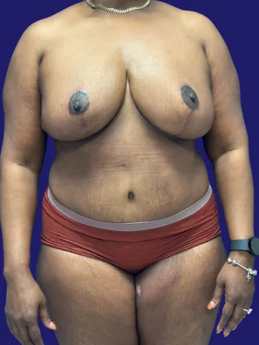 Tummy Tuck Case #5907 — after, Dr. Frank Albino