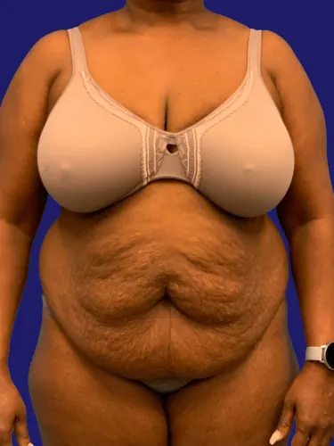 Tummy Tuck Case #5907 — before, Dr. Frank Albino