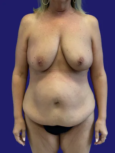 Tummy Tuck Case #6263 — before, Dr. Frank Albino
