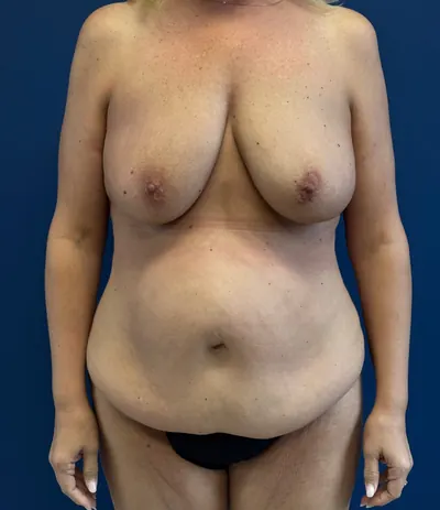 Tummy Tuck Case #6263 — before, Dr. Frank Albino