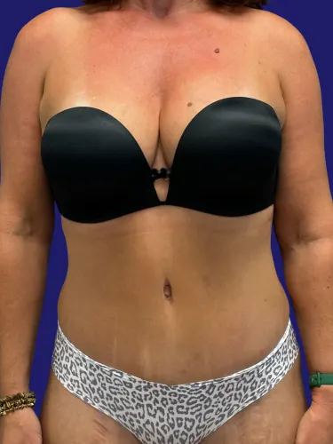Tummy Tuck Case #7009 — after, Dr. Frank Albino