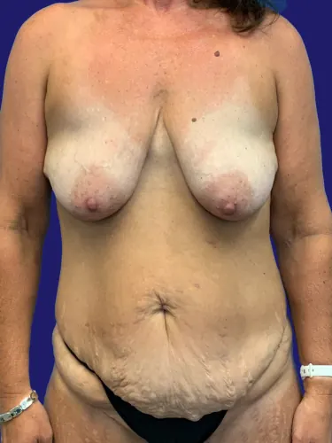 Tummy Tuck Case #7009 — before, Dr. Frank Albino