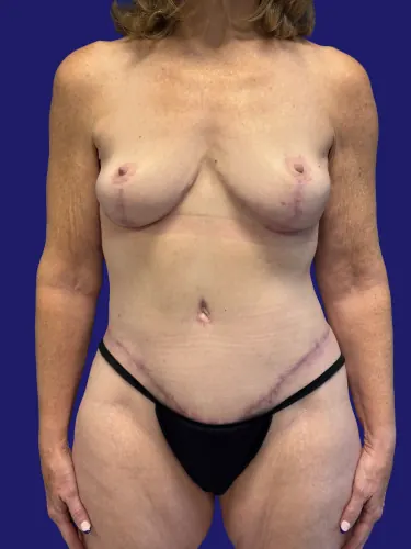 Tummy Tuck Case #7412 — after, Dr. Frank Albino