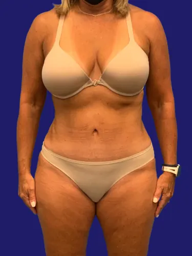 Tummy Tuck Case #7924 — after, Dr. Frank Albino