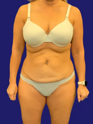 Tummy Tuck Case #7924 — before, Dr. Frank Albino