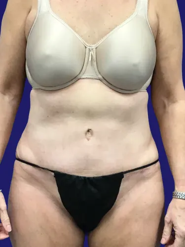 Tummy Tuck Case #7963 — after, Dr. Frank Albino