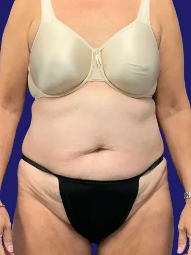 Tummy Tuck Case #7963 — before, Dr. Frank Albino