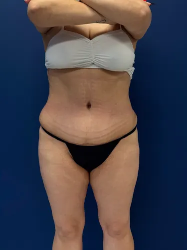 Tummy Tuck Case #7989 — after, Dr. Samir Rao