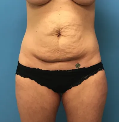 Tummy Tuck Case #244 — before, Dr. Samir Rao