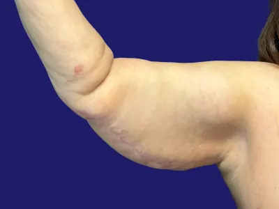 Arm Lift Case #5646320 — after, Dr. Frank Albino