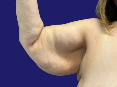 Arm Lift Case #5646320 — before, Dr. Frank Albino