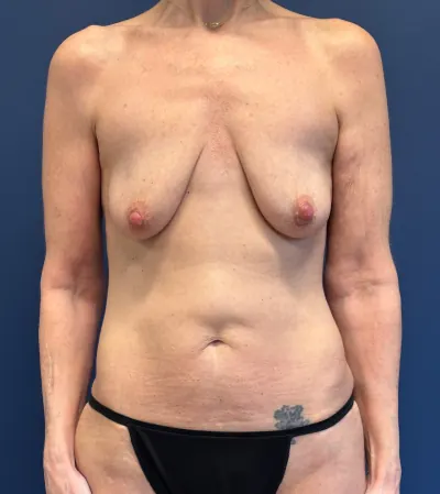 Breast Augmentation with Lift Case #7491 — before, Dr. Arjun Kanuri