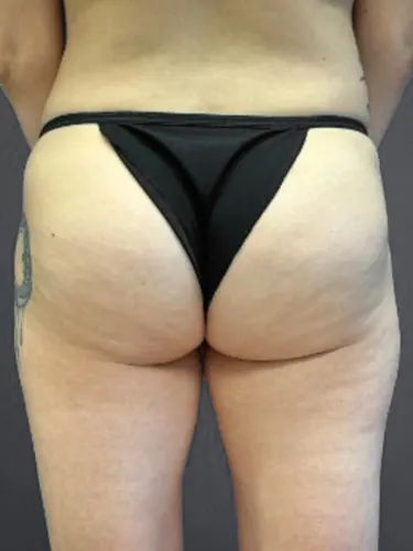 Avéli (Cellulite) Case #6987 — before, Dr. Arjun Kanuri