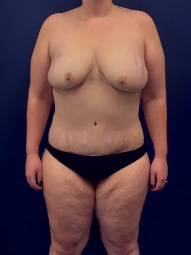 DIEP Flap Case #1108 — after, Dr. Samir Rao