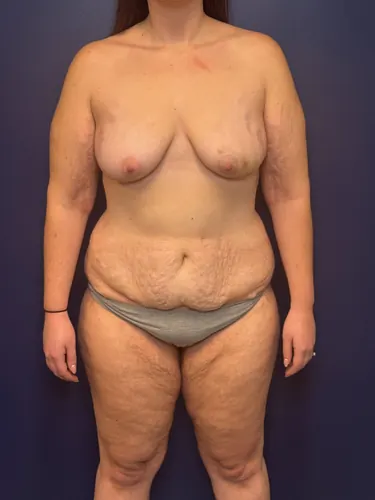 DIEP Flap Case #1108 — before, Dr. Samir Rao